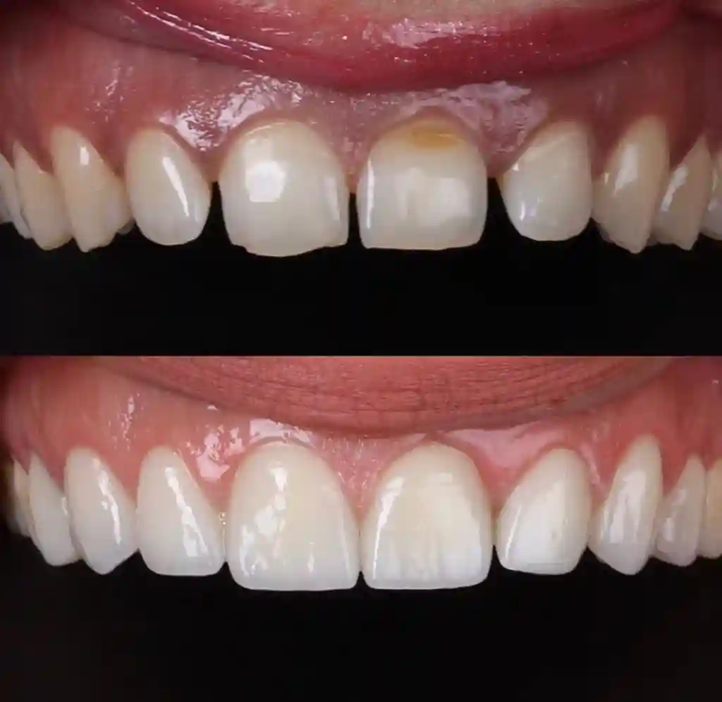 Smile makeover cosmetic dentistry